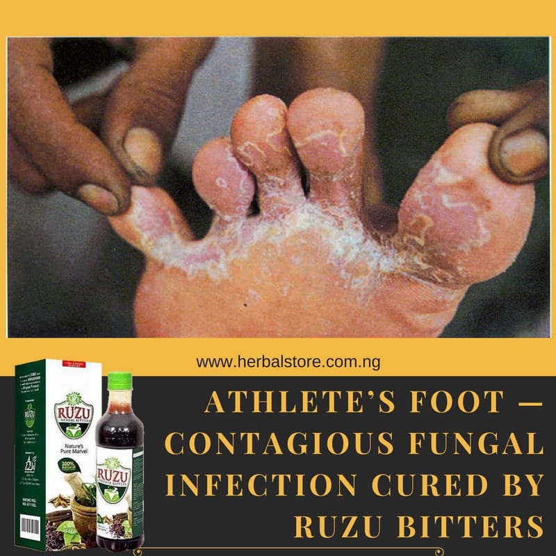 Athlete’s foot — Contagious Fungal Infection Cured By Ruzu Bitters